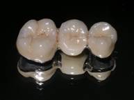 conventional dental bridge